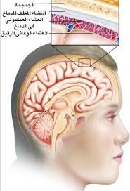 اسباب التهاب السحايا - علاج هذا الالتهاب المؤلم 5057