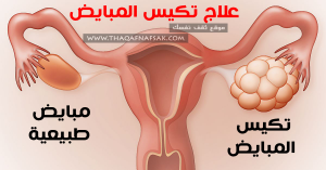 الي كان عندها كيس على المبيض واختفى تدخل ضروري