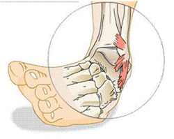 علاج التواء الكاحل وتمزق الاربطة , الحل البسيط لتمزق الاربطه